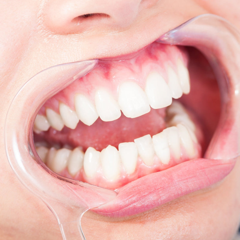 Mondspreider - No Yellow Teeth